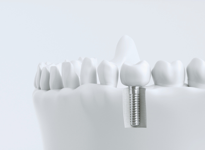 clínica dental implate dental