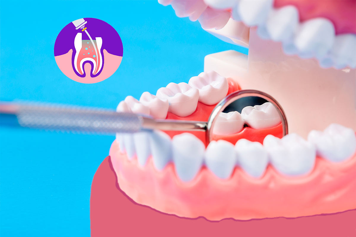 Endodoncia en Plasencia